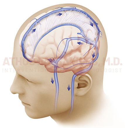 Idiopathic Intracranial Hypertension (IIH)