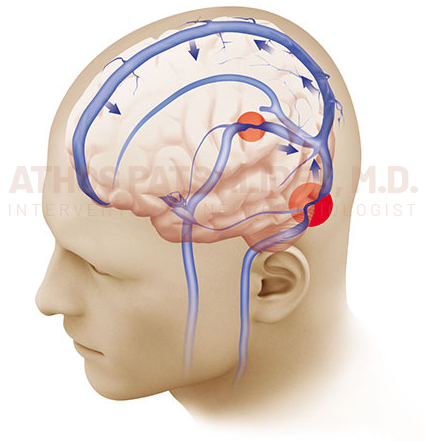 Idiopathic Intracranial Hypertension (IIH)