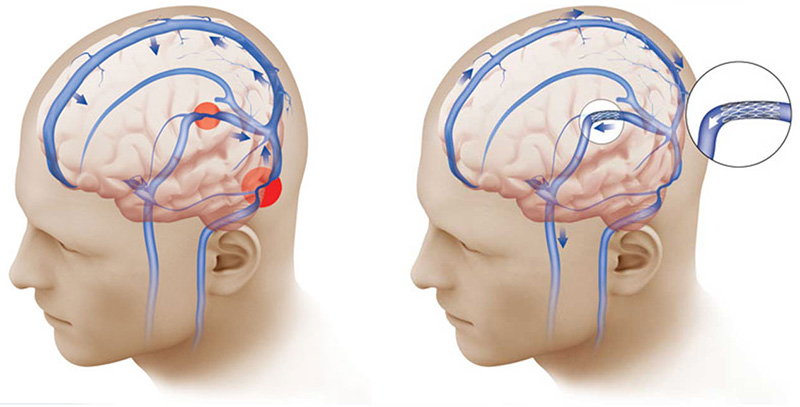 Dural Arteriovenous Fistulas