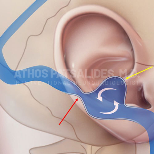 Pulsatile Tinnitus