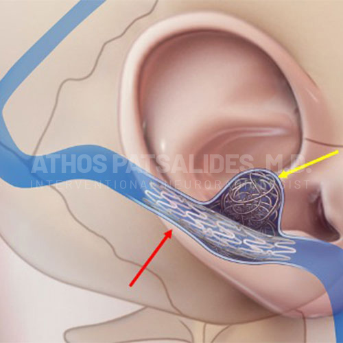 Pulsatile Tinnitus