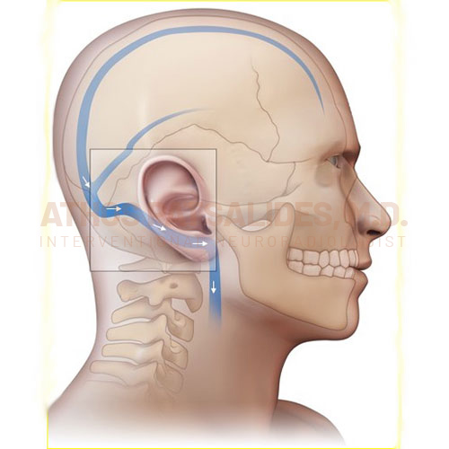 Pulsatile Tinnitus