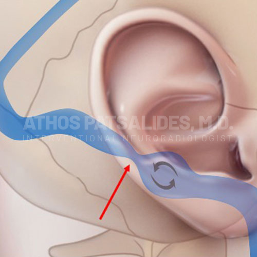 Pulsatile Tinnitus