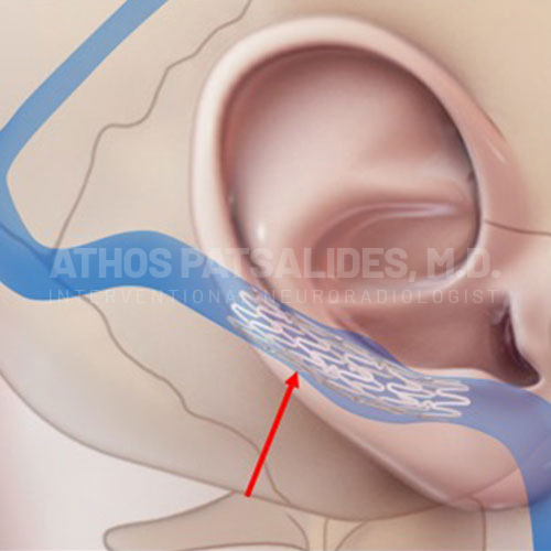 Pulsatile Tinnitus