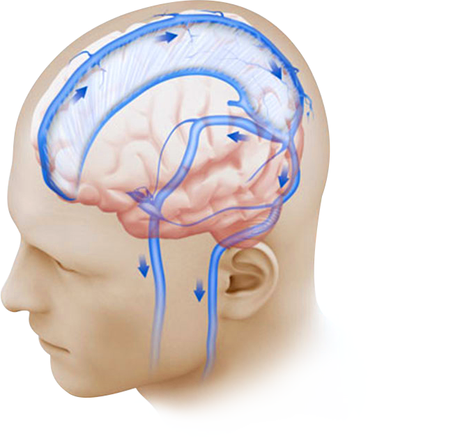 Venous Sinus Stenting